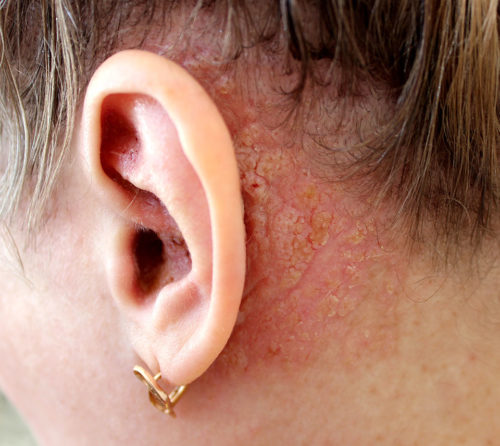 example of darriers disease behind ear